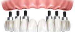 proteses-varginha-1376496974